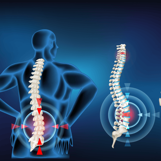 The Point of Relief: Does Acupuncture Help Herniated Discs?